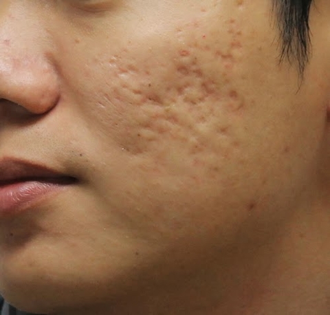 Trị sẹo lõm từ tự nhiên