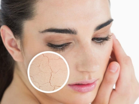 3 CÁCH TRỊ NÁM CHO DA KHÔ