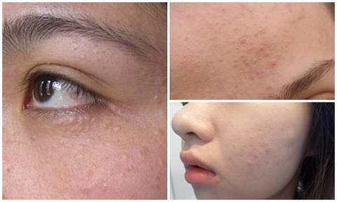 Cách điều trị mụn ẩn hiệu quả