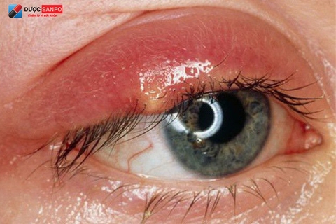 Viêm mí mắt: Nguyên nhân, biểu hiện và cách điều trị