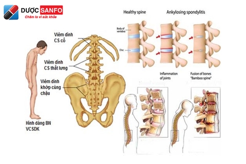 Viêm cột sống dính khớp: Biểu hiện, phương pháp chẩn đoán & điều trị