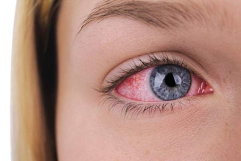 Viêm màng bồ đào và những biến chứng nghiêm trọng đối với thị lực