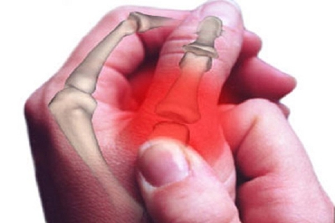 Cách phân biệt bệnh viêm khớp và bệnh gút