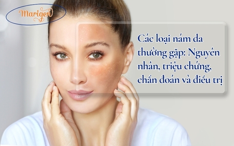 Các Loại Nám Da Thường Gặp: Nguyên Nhân, Triệu Chứng, Chẩn Đoán Và Điều Trị
