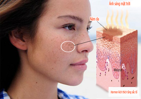 Nguyên nhân gây nám da và Cách trị nám da mặt hiệu quả tại nhà