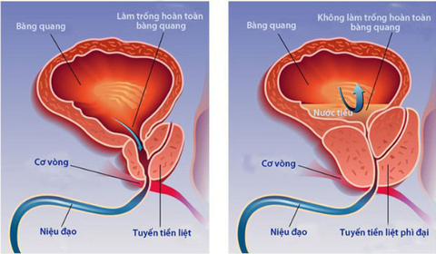 Phì đại tuyến tiền liệt: Triệu chứng, nguyên nhân và các biến chứng