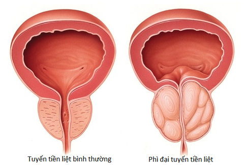 Bệnh Phì đại tiền liệt tuyến có nguy hiểm không? Cách phát hiện bệnh sớm