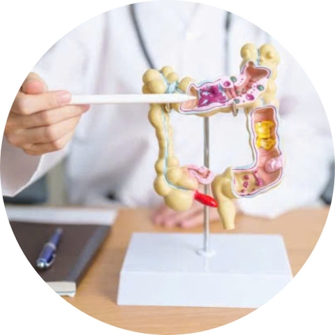 Vi khuẩn đường ruột của người trẻ có thể dẫn đến nguy cơ ung thư đại trực tràng