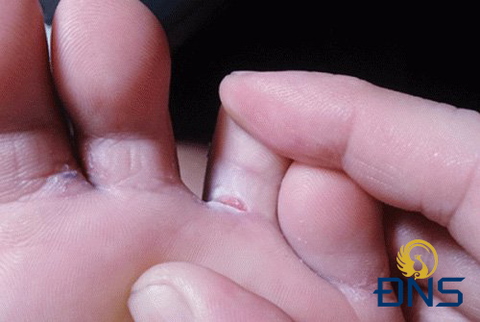 Cách điều trị bệnh nấm kẽ chân như thế nào?