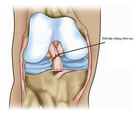 Chấn thương dây chằng chéo sau: Nguyên nhân, triệu chứng, chẩn đoán và điều trị