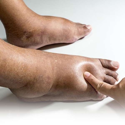 Chân voi: Nguyên nhân, triệu chứng, chẩn đoán và điều trị