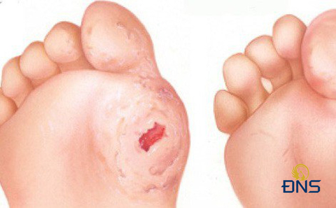 Những vấn đề gặp phải của việc ngâm chân không đúng cách