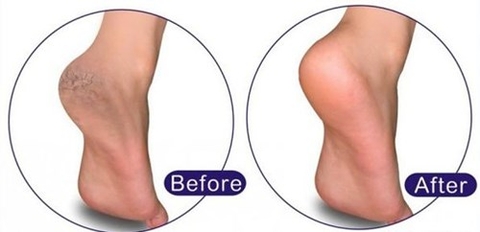 Bồn ngâm chân thế hệ mới đặc trị nứt nẻ gót chân