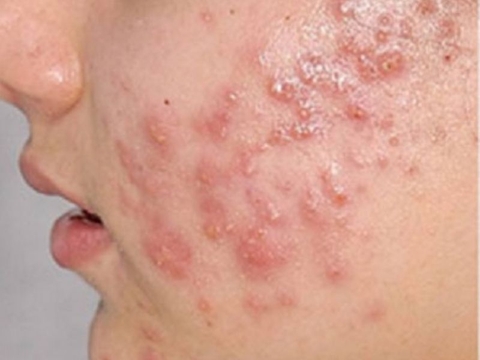 3 loại mụn nguy hiểm tuyệt đối không nặn