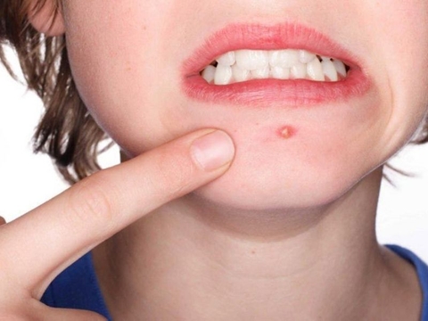 5 cách trị mụn bọc ở cằm không đau