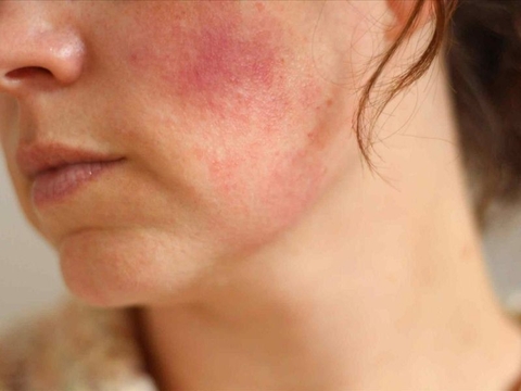 Da nhiễm corticoid là gì? Dấu hiệu giúp nhận biết da bị nhiễm corticoid