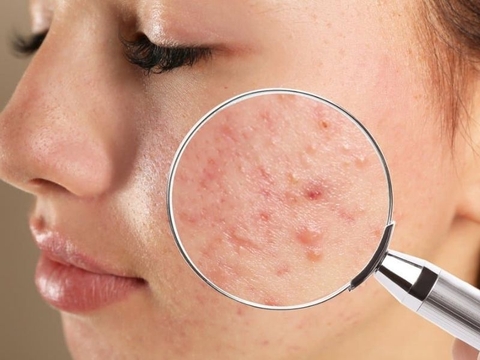 Dùng AHA bị đẩy mụn và cách chăm sóc da hiệu quả