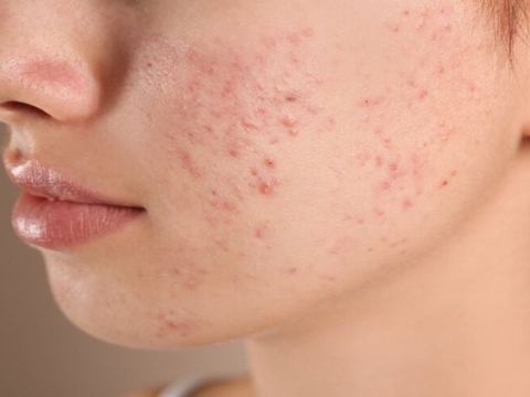 Các loại mụn và cách điều trị hiệu quả nhất