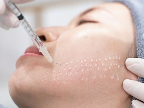 Tiêm meso - Bí quyết làm đẹp da toàn diện đang cực HOT hiện nay