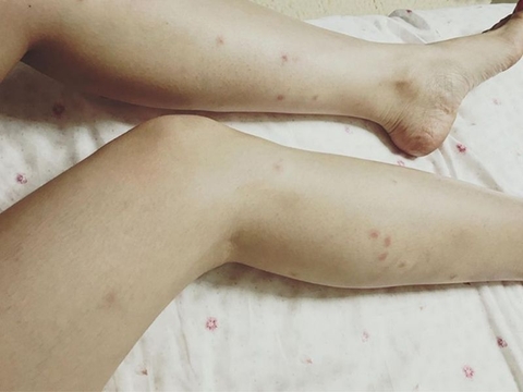 Cách trị sẹo thâm ở chân cực nhanh chỉ sau 1 tuần