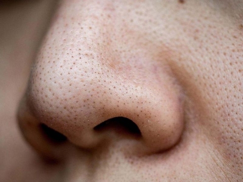 Các vị trí mọc mụn trên mặt và cách chữa đúng