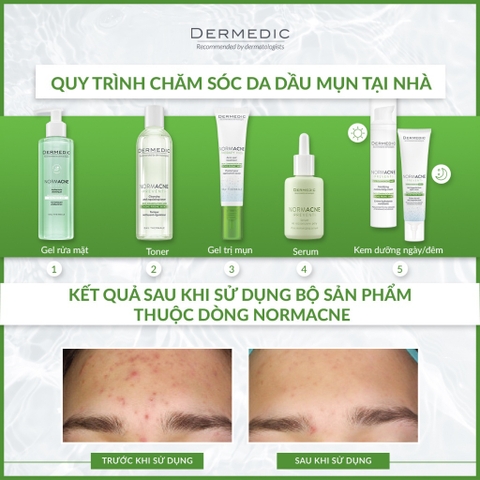 Toner da dầu mụn, làm dịu, se khít lỗ chân lông Dermedic Normacne Preventi Cleansing And Regulating Skin Toner 200ml