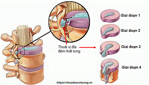 Đặc điểm lâm sàng đau thần kinh hông to là gì?