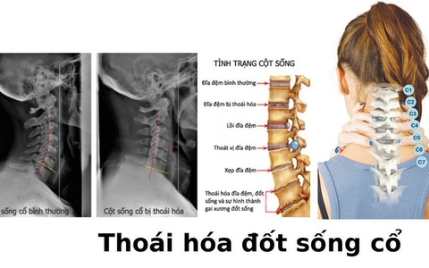 Thoái hóa cột sống cổ theo y học cổ truyền