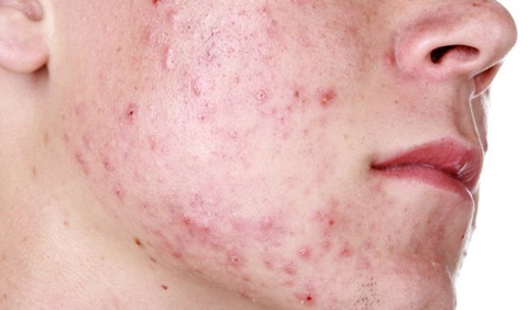 CÁCH CHĂM SÓC VÀ ĐIỀU TRỊ DA DẦU MỤN