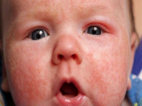 CHÀM SỮA Ở TRẺ SƠ SINH - NGUYÊN NHÂN CÁCH ĐIỀU TRỊ