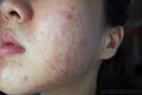 KEM PHỤC HỒI DA HƯ TỔN UREA PHÙ HỢP VỚI ĐỐI TƯỢNG NÀO?