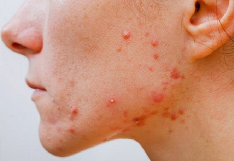 HƯỚNG DẪN PHỤC HỒI DA HƯ TỔN TẠI NHÀ