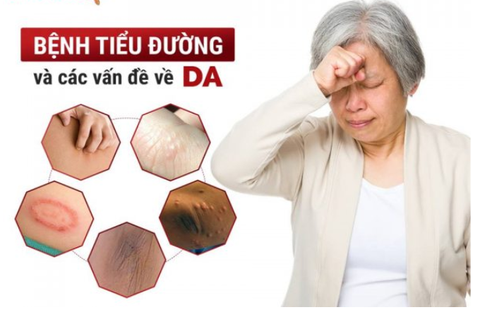 Cách dưỡng ẩm da hiệu quả dành cho người bị tiểu đường