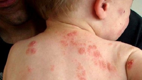 Xử lý và phòng ngừa cho trẻ bị dị ứng do côn trùng cắn