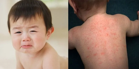 TRẺ BỊ NỔI MẨN ĐỎ MỀ ĐAY CÓ NGUY HIỂM KHÔNG?