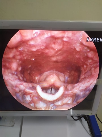 Các bước nội soi Tai Mũi Họng Thông Thường