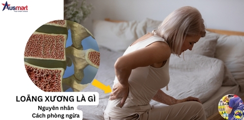 Bệnh loãng xương - Nguyên nhân và Cách phòng ngừa