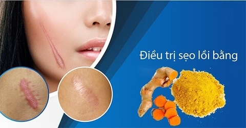 Top 3 cách trị sẹo lồi bằng nghệ siêu hiệu quả và tiết kiệm