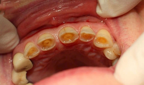 Mòn mặt nhai răng hàm có sao không? Nguyên nhân và cách điều trị răng hàm bị mòn mặt nhai Mòn mặt nhai răng hàm có sao không? Nguyên nhân và cách điều trị răng hàm bị mòn mặt nhai
