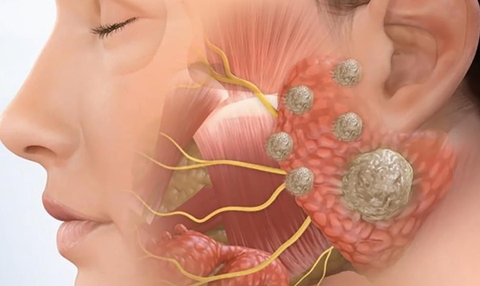 Ung thư răng hàm mặt cách phòng tránh bệnh Ung thư răng hàm mặt cách phòng tránh bệnh