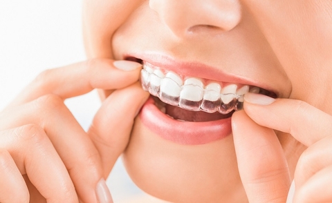 Niềng răng hàm dưới và hàm trên mất bao lâu? Mất răng hàm có niềng răng được không? Niềng răng hàm dưới và hàm trên mất bao lâu? Mất răng hàm có niềng răng được không?