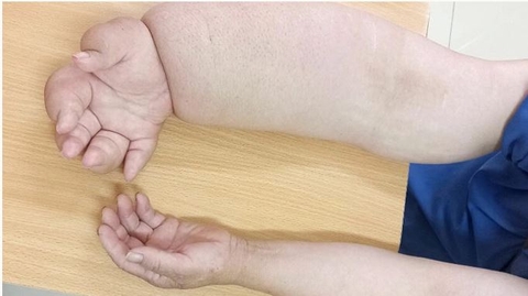 PHÙ TAY VOI SAU UNG THƯ VÚ – ĐỪNG CHỊU ĐỰNG ÂM THẦM, ĐÃ CÓ GIẢI PHÁP HIỆU QUẢ TẠI TRUNG TÂM VIỆT – PHÁP