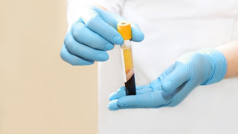 Tiêm PRP - Phương pháp trị liệu sinh học cho vết thương mãn tính