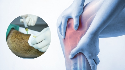 Thoái hóa khớp gối và cách điều trị bệnh hiệu quả