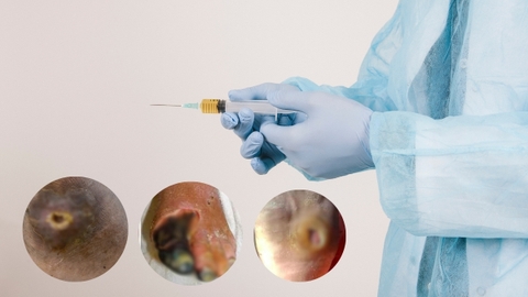 Vết thương mãn tính là gì? Phương pháp tiêm PRP điều trị vết thương mãn tính hiệu quả