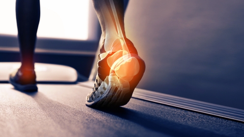 Viêm gót chân Achilles là gì? Chăm sóc và điều trị viêm gót chân hiệu quả