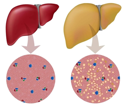 Các mẹo dân gian chữa bệnh gan nhiễm mỡ hiệu quả tại nhà