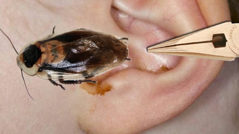 Gián chui vào tai mũi: Nguy hiểm tiềm ẩn và cách xử trí an toàn