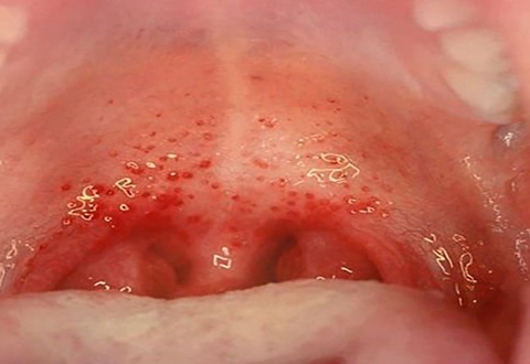 Phòng và xử lý viêm họng đúng cách để trẻ không bị biến chứng nguy hiểm