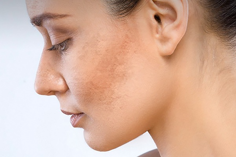 Nám da sau điều trị có bị tái lại không? Cách phòng ngừa nám da tái lại sau điều trị